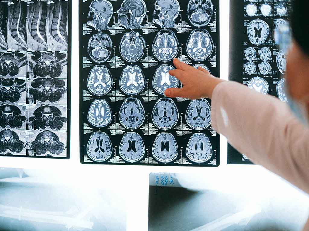 Efectos del cannabis en el cerebro